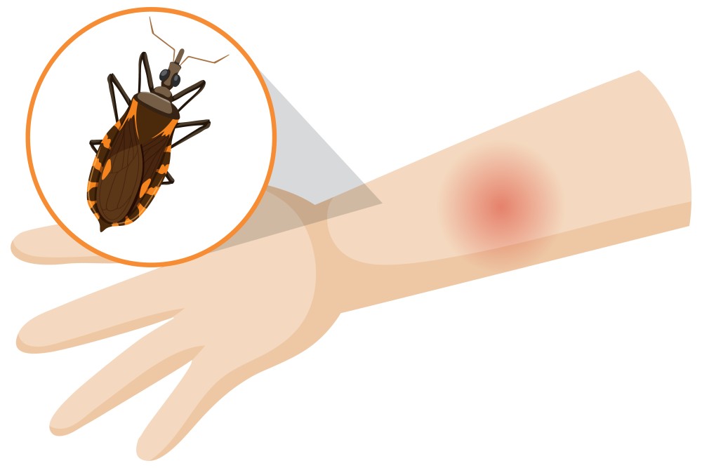 Tick Bites