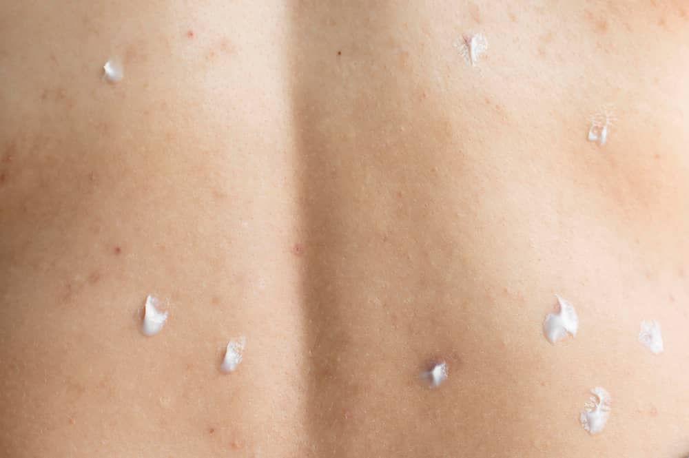 Protecting Your Family from Lyme Disease Through Tick Control in Brampton