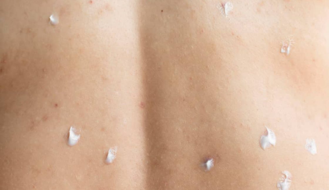 Protecting Your Family from Lyme Disease Through Tick Control in Brampton